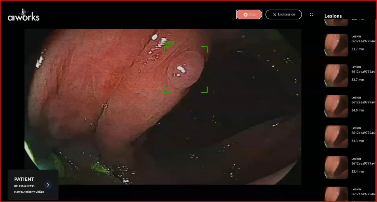 Aiworks colonoscopy